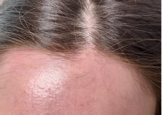 Foto clínica de línea de implantación del pelo. En la línea de implantación se observan algunas áreas alopécicas incipientes y algunas pápulas faciales en la región de la frente.