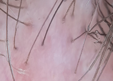 Foto de tricoscopia de línea de implantación. Acercamiento de las vainas peripilares.
