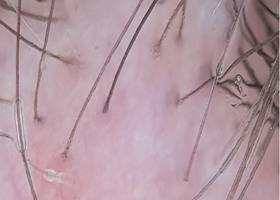 Foto de tricoscopia de línea de implantación. Se observan pelos solitarios, ausencia de ostium foliculares, áreas blancas lechosas interfoliculares, vasos cortos retorcidos, vainas peripilares.
