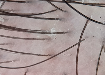 Foto de tricoscopia de línea de implantación. Se observa leve eritema perifolicular, descamación perifolicular y unidades foliculares con un solo tallo piloso